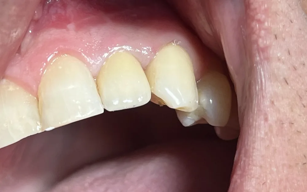 Nadoknada jednog zuba na implantatu — poslije terapije