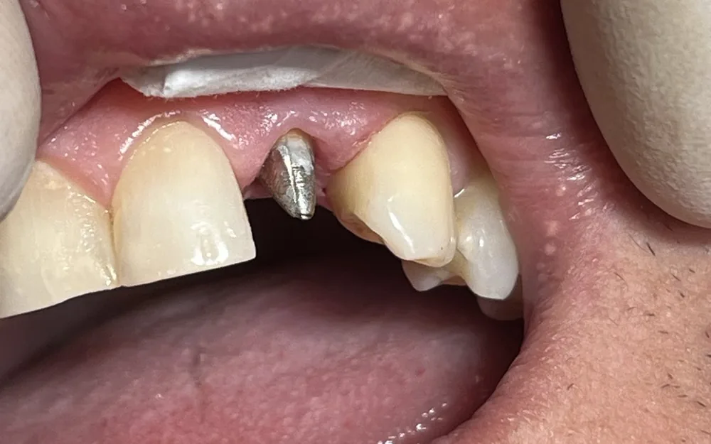 Nadoknada jednog zuba na implantatu — prije terapije